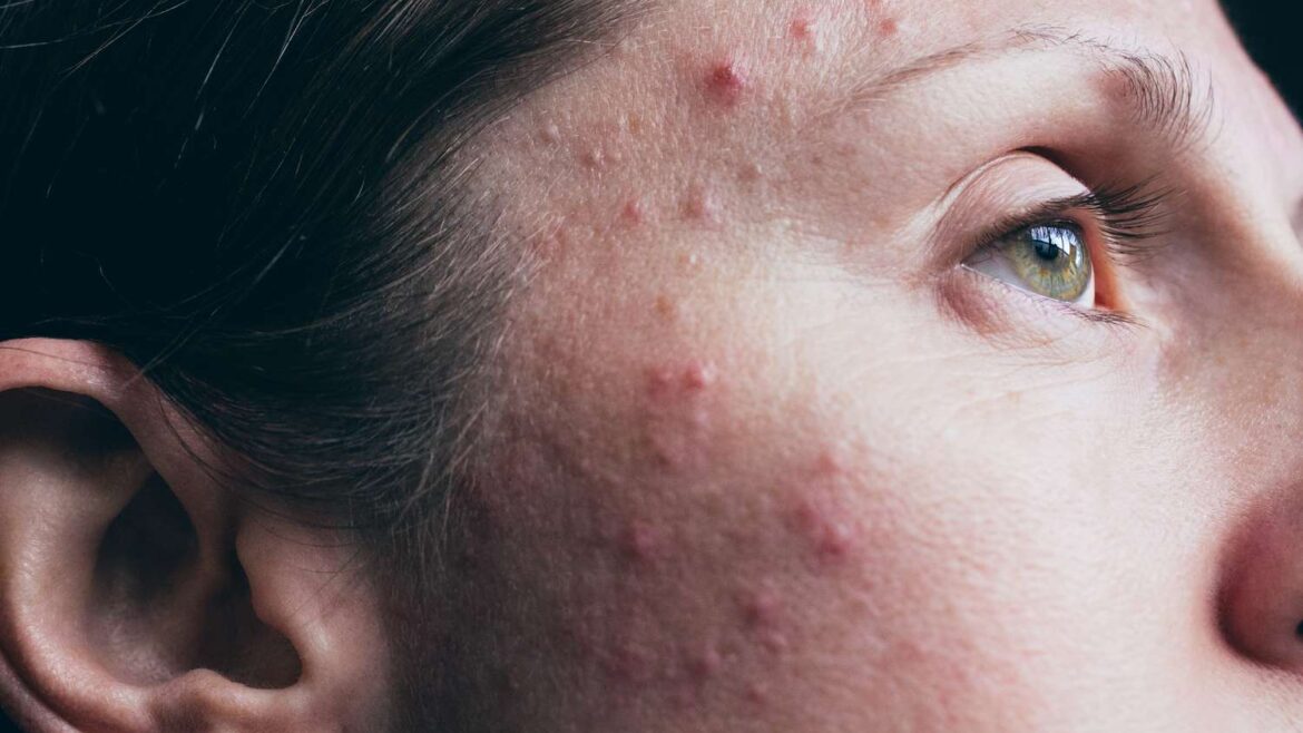 can magnesium cause acne