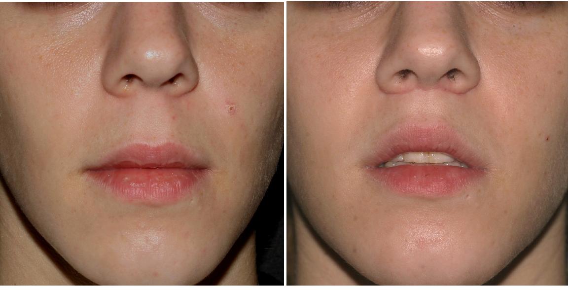 lip fillers dissolved after 1 week