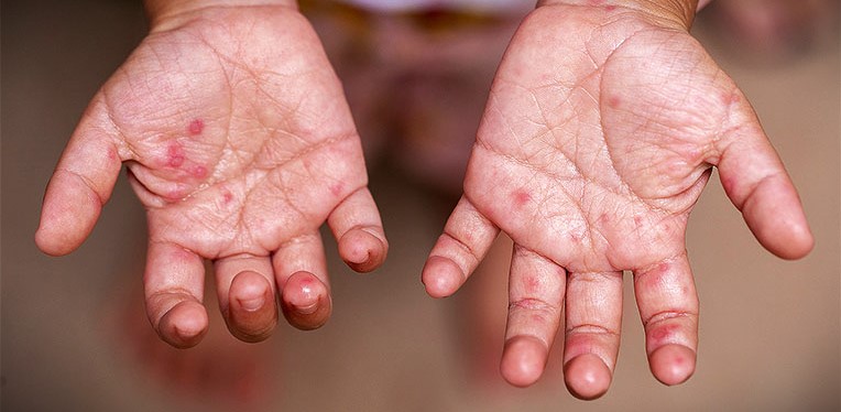 benadryl hand foot and mouth disease